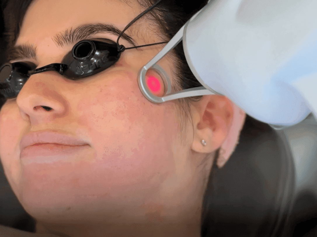Fractional Laser