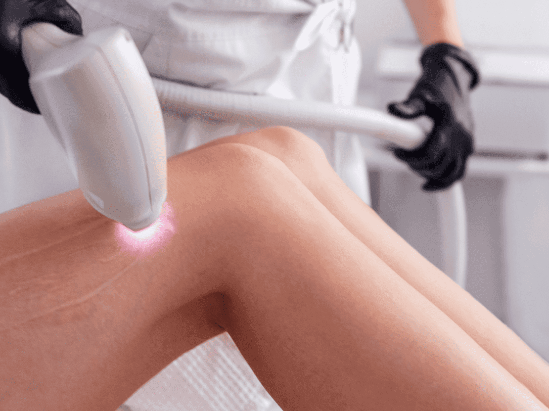 Hair/Tatoo Removal