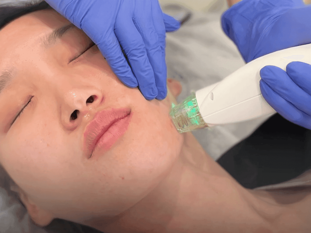 Microneedling