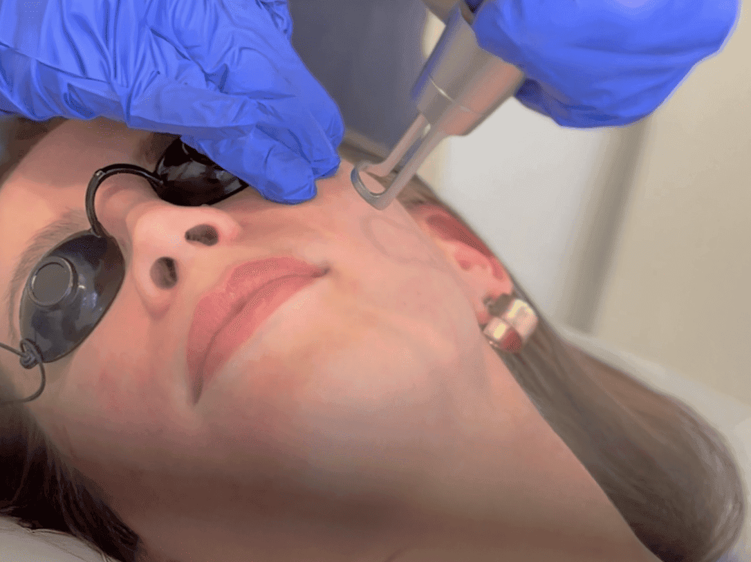 Pigment Laser