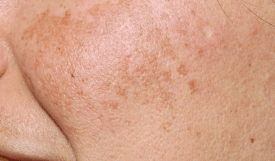 Why You Shouldn’t Remove Melasma and Dark Spots Anywhere Without Care at MeSO Medspa