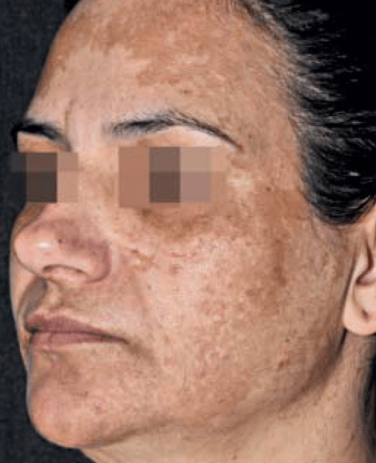 Why Melasma Appears on Once-Clear Skin