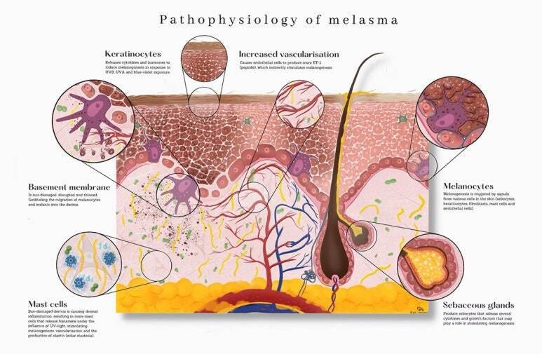 Understanding the Severity of Melasma and Pigmentation Issues: At MeSO MedSpa in Newport Beach