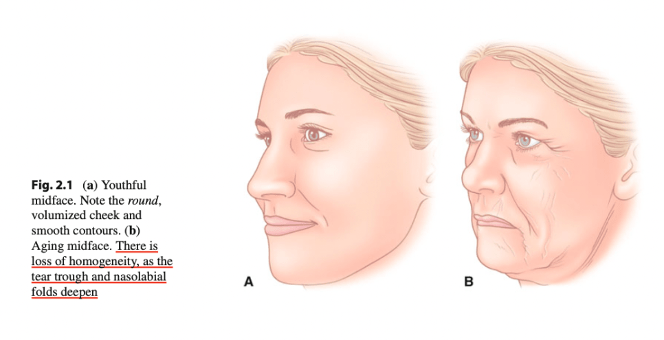 Midface Aging Correction: Expert Filler Approach by MeSO Medspa Newport Beach