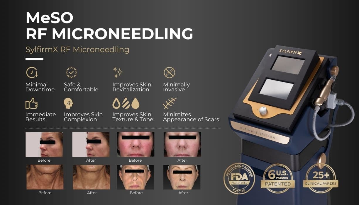 MeSO RF Microneedling