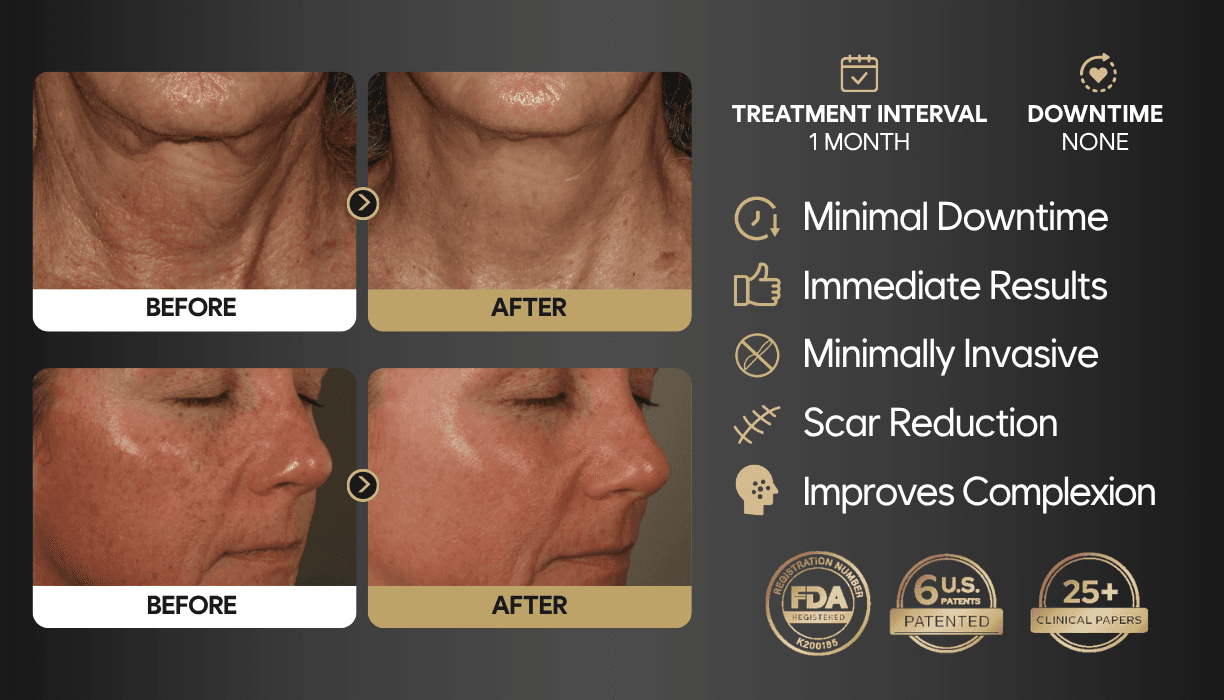 MeSO RF Microneedling