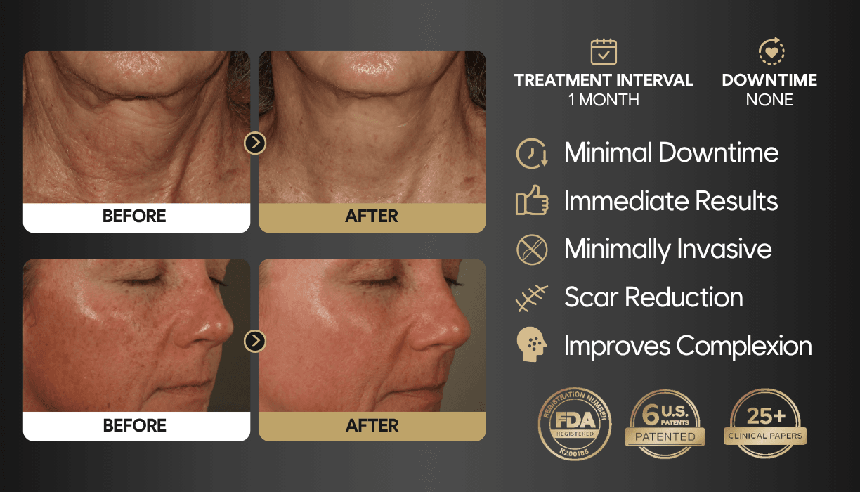 MeSO RF Microneedling