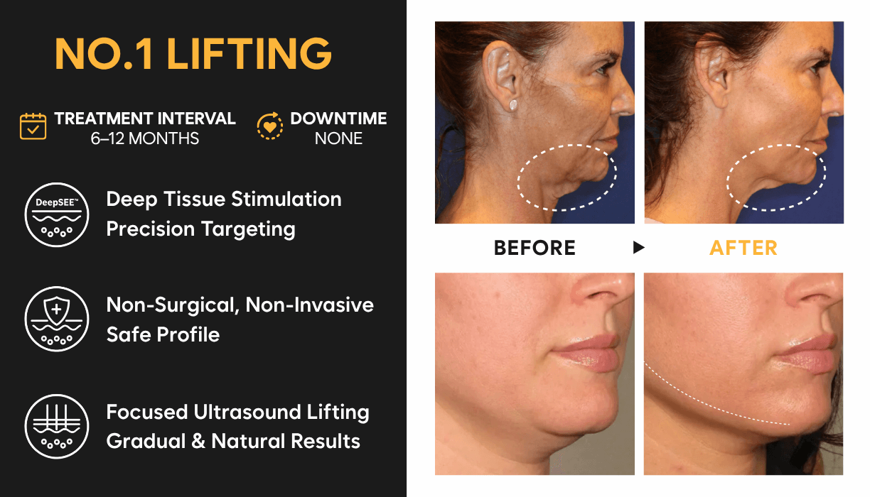 Ultherapy Prime